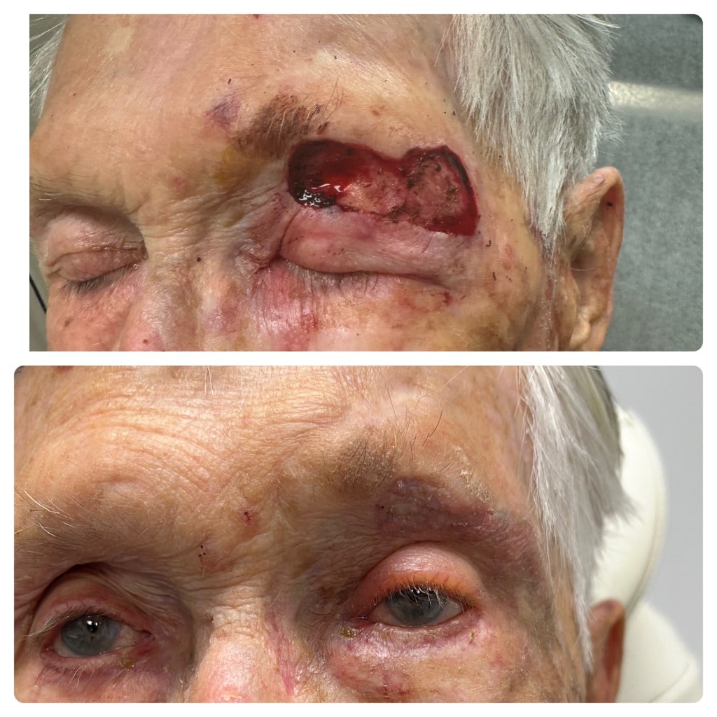Before and after forehead and eyebrow reconstruction
