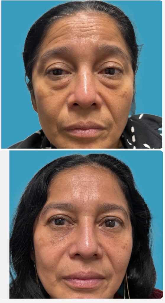 Before and after lower blepharoplasty showing under-eye rejuvenation