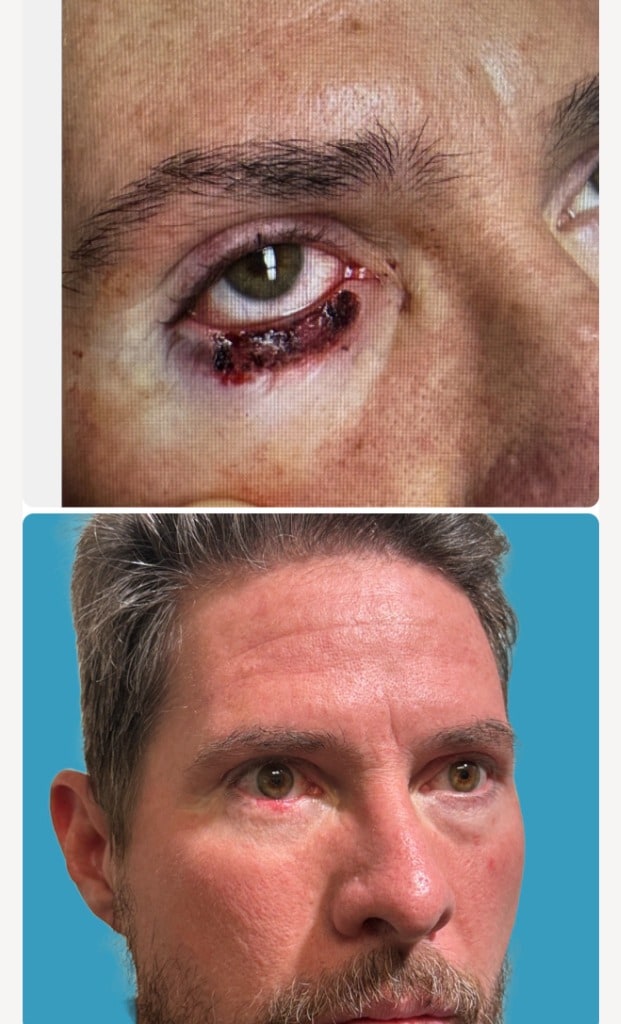 Before and after Mohs cancer removal eyelid reconstruction